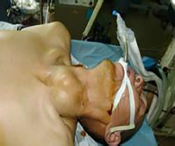 自主性高功能性甲狀腺瘤的