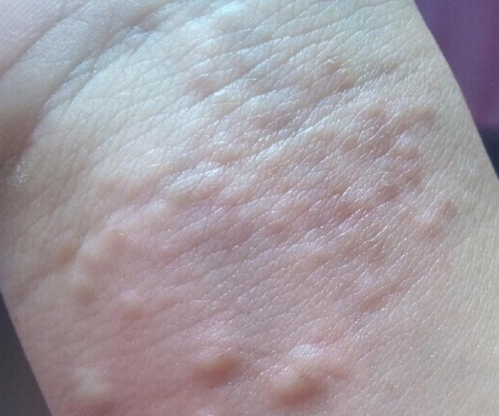 腹膜後淋巴瘤症狀 