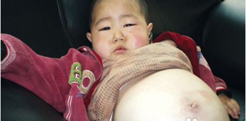 小孩糖尿病腎病肚子腫大