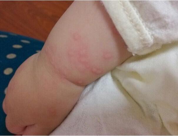 小兒急疹的症狀 (43) 