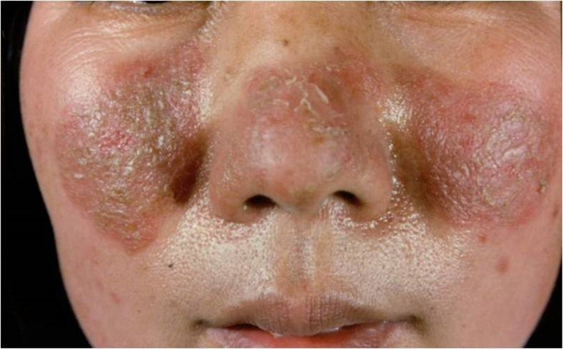 女性紅斑型大皰性皮膚病