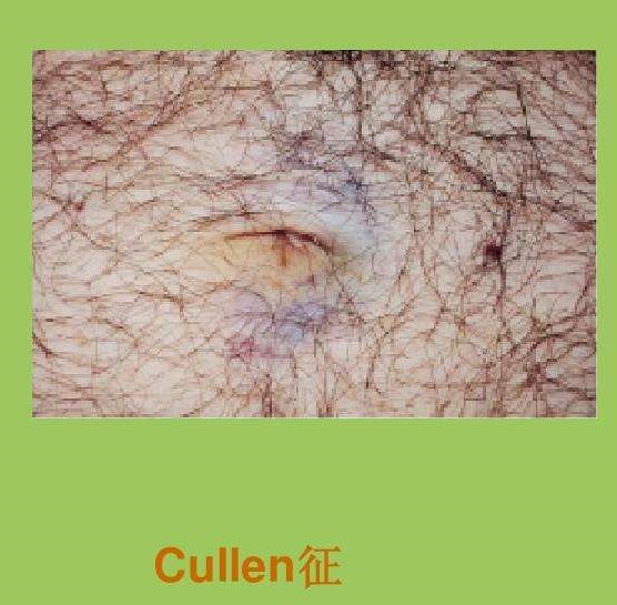 重症急性胰腺炎腹部體徵