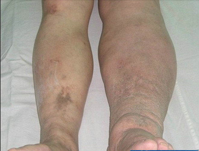 糖尿病腎病腿部腫大