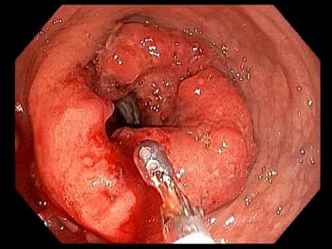 右半結腸癌潰瘍型常見臨床 特點