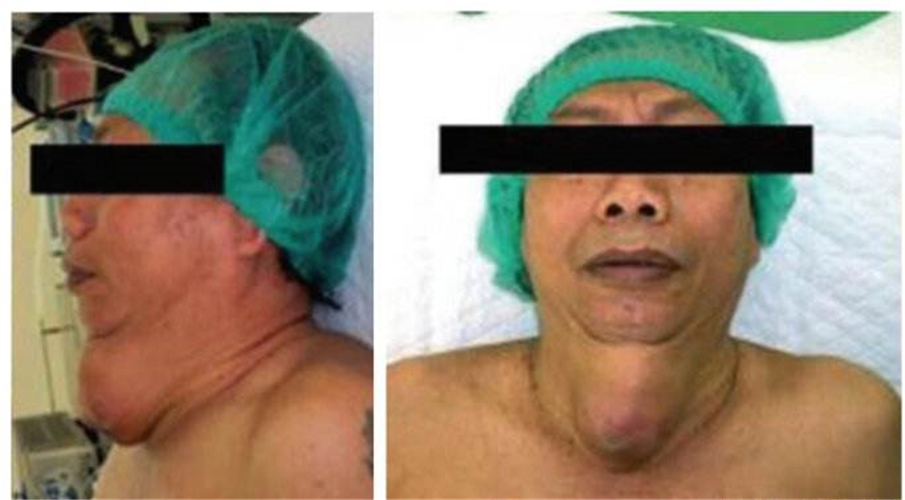 中年女性甲狀腺癌