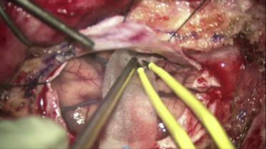 硬腦膜下腔解剖圖 