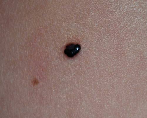 黑痣癌變
