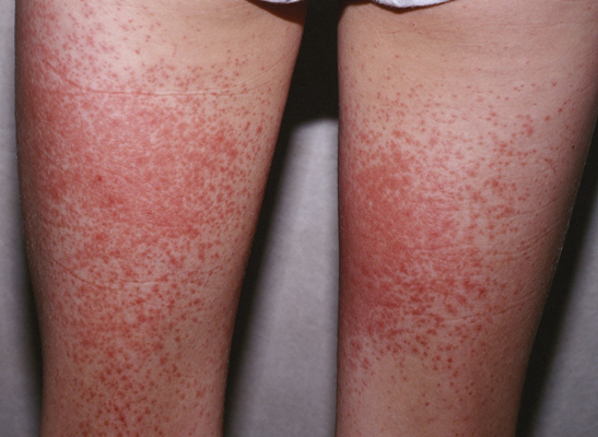 艾滋病紅疹症狀