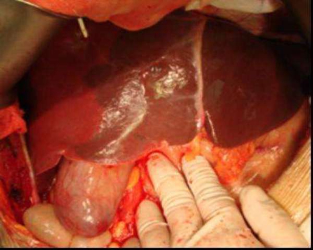 內膽管癌早期症狀