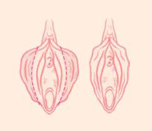 一側陰唇肥大搔癢