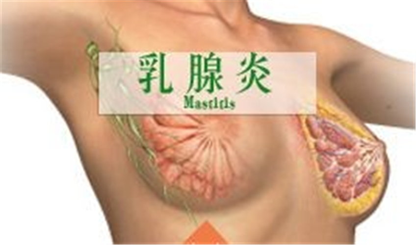乳腺炎