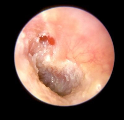 挖耳朵鼓膜穿孔