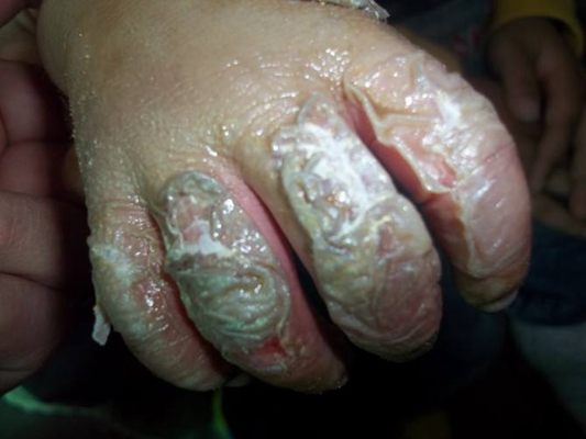 深二度燒傷 (36) 