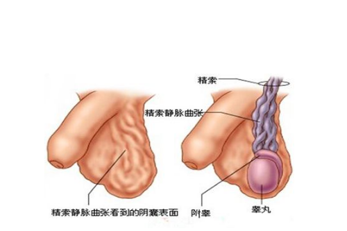 精索曲張睪丸下墜時