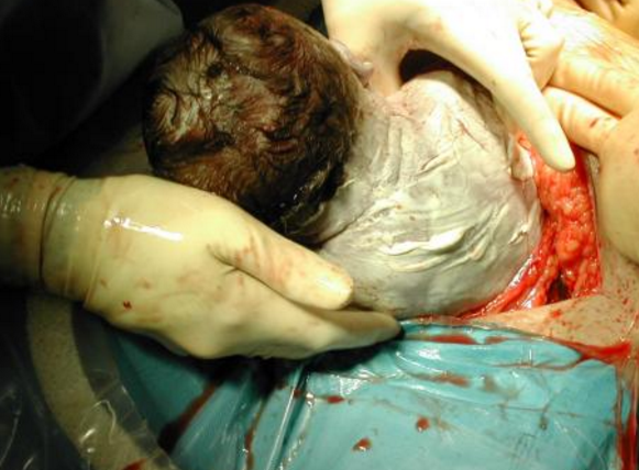 剖腹產手術 (58) 