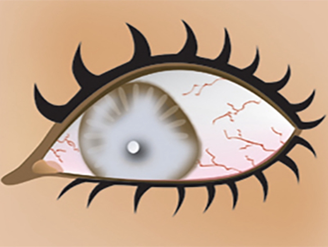 原發性開角型青光眼