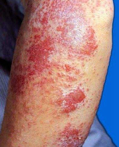 艾滋病紅疹症狀