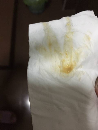 先兆流產分泌物