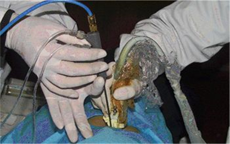 硬化治療腎囊腫