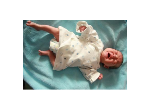 痙攣型腦癱 (61) 