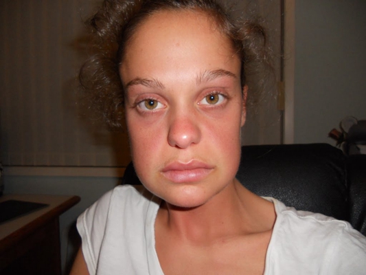 腮腺炎的症狀和