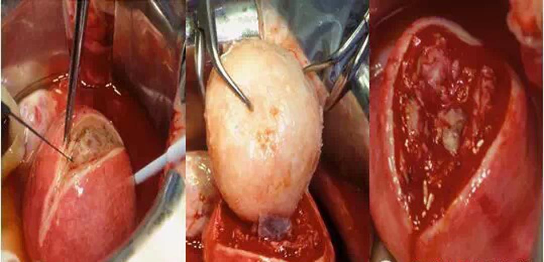 子宮肌瘤取出過程