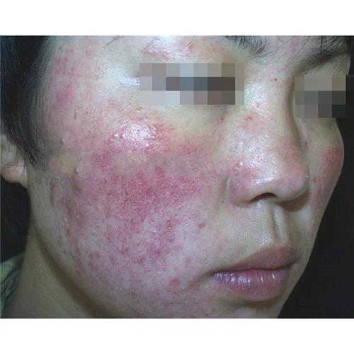 臉接觸性皮炎脫皮