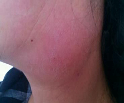 頜下淋巴結腫大