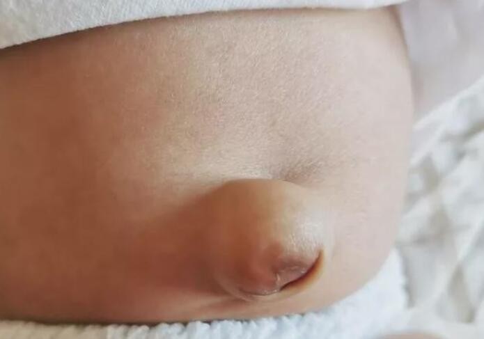 男寶寶疝氣的症狀