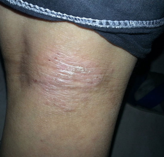 腿部瘙癢的異位性皮炎