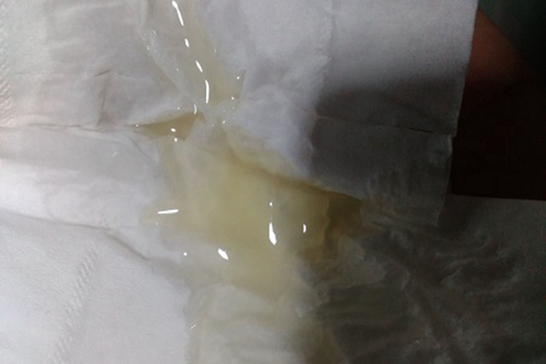 不正常精液液化