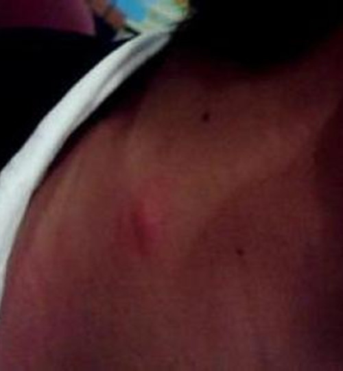 鎖骨上的淋巴結核