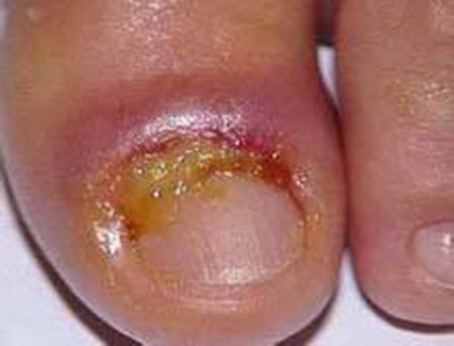 腳指甲周炎的症狀和