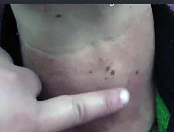 自身免疫性甲狀腺炎症狀