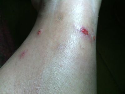 被跳蚤咬的症狀