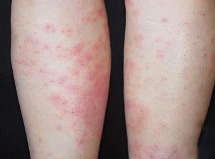 系統性紅斑狼瘡診斷標準 (40) 