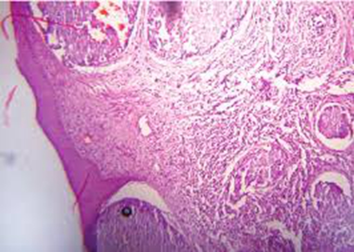 早期陰莖癌細胞圖的