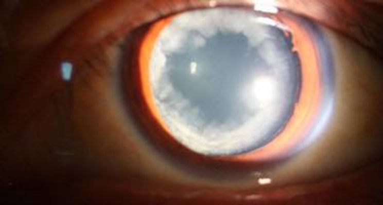 白內障的早期症狀