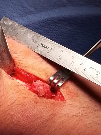 脛骨結節骨骺炎 (37) 