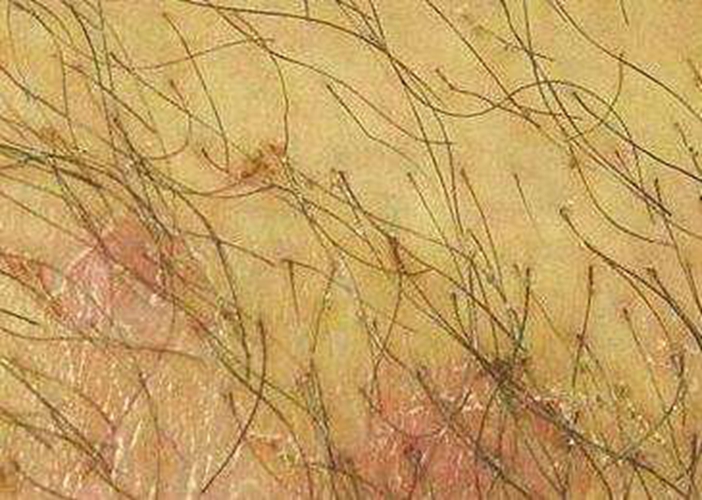 陰蝨的症狀表現