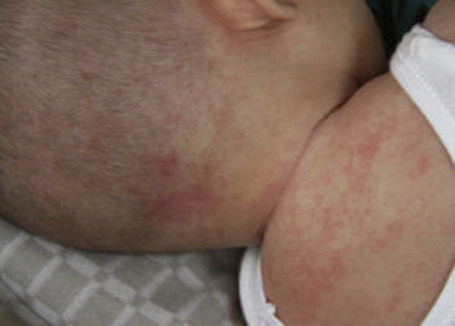 小兒急疹的症狀 (6) 