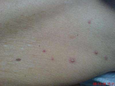 慢性淋巴結炎 (47) 