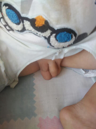 男寶寶疝氣的症狀