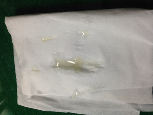 不正常精液液化