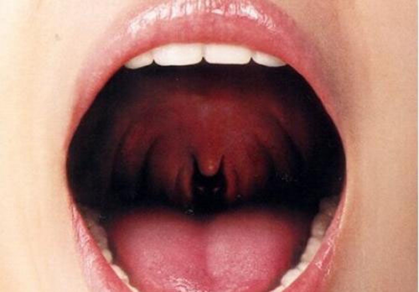 未患喉血管瘤的