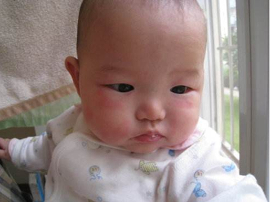 新生兒胎毒的症狀