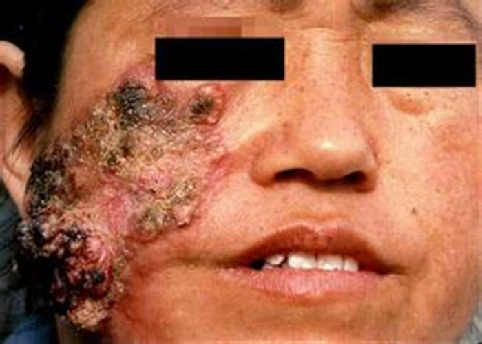 疣狀皮膚結核病