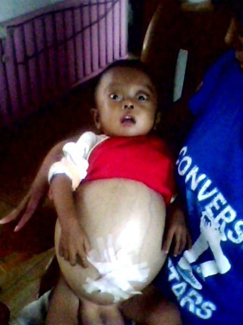 小孩患有腹水危害