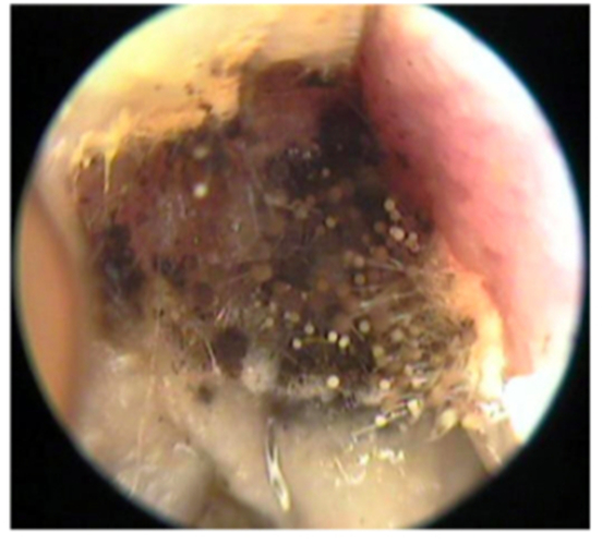 真菌性外耳道炎的
