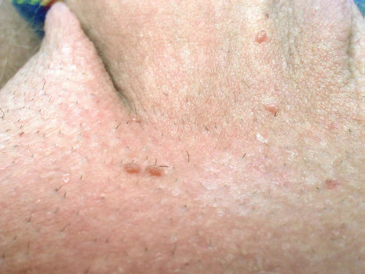 男性尖銳溼疣照片 (46) 